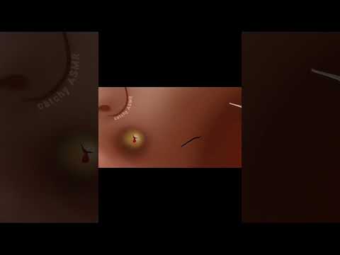 Pus removal animation|| ASMR animation|| #asmranimation #animation #asmrvideo
