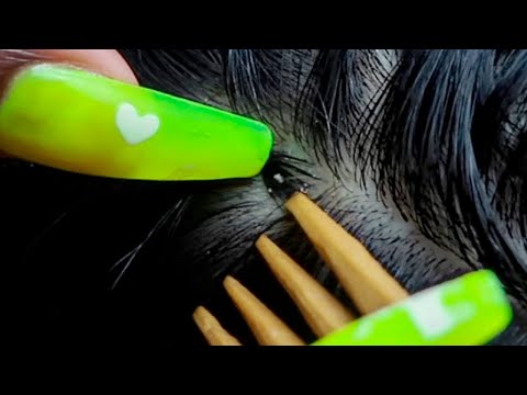 {ASMR} Super Attentive Nitpicking Scalp Whiteheads | XMAS Special🎄