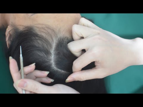 ASMR Real Person Hair Parting And Scratching, Relaxing Hair Sounds For Headache Relief