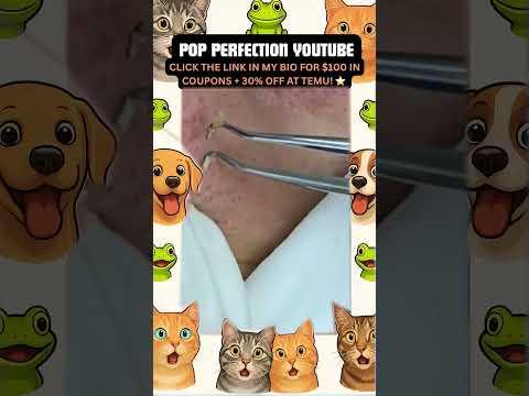 Wow! #pimpleremoval #pimple #pimples #shortsfeed #shortvideo #shorts #short #youtube #youtubeshorts