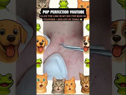 Wow! #pimpleremoval #pimple #pimples #shortsfeed #shortvideo #shorts #short #youtube #youtubeshorts