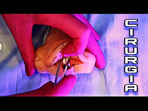 ASMR CIRÚRGICO: DESVIO DE SEPTO ( cirurgia no nariz)