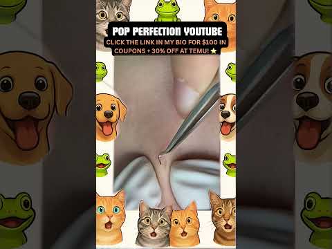 Wow! #pimpleremoval #pimple #pimples #shortsfeed #shortvideo #shorts #short #youtube #youtubeshorts