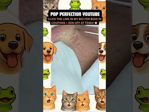Wow! #pimpleremoval #pimple #pimples #shortsfeed #shortvideo #shorts #short #youtube #youtubeshorts