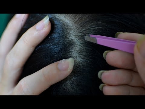 ASMR Scalp Check / Scalp Scratching / Real Person Scalp Treatment