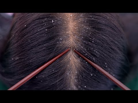 ASMR Scalp Check / Scalp Scratching With Chopsticks / The Scalp Itchy