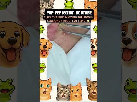 Wow! #pimpleremoval #pimple #pimples #shortsfeed #shortvideo #shorts #short #youtube #youtubeshorts