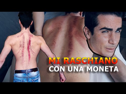 HO PROVATO il GUASHA la TERAPIA di RASCHIATURA CINESE!