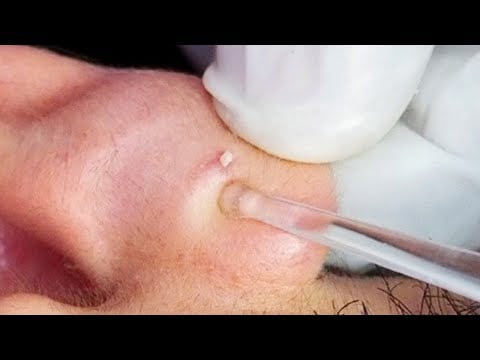 ASMR | The Most Tingly Ear Check-up, Picking, Cleaning and Massage.