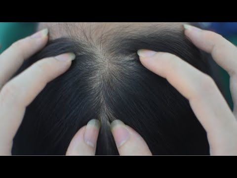 ASMR Head Massage, Head Scratching Real Person, Therapy Sounds For Relieve Headache, Anxiety, Stress