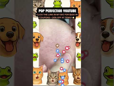 Wow! #pimpleremoval #pimple #pimples #shortsfeed #shortvideo #shorts #short #youtube #youtubeshorts
