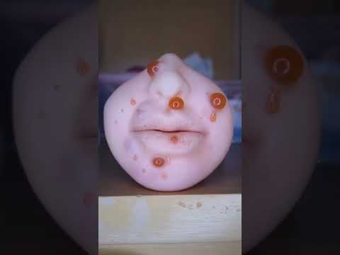 Tratamento de acne removendo espinhas - ASMR #shorts
