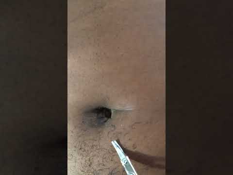 ASMR REMOVING INGROWN HAIR ON NAVEL #tingly #skincare #tinglyfeeling #nitpicking