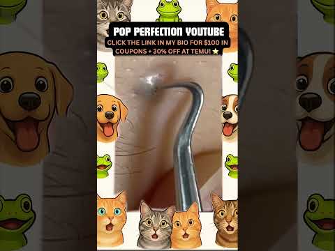 Wow! #pimpleremoval #pimple #pimples #shortsfeed #shortvideo #shorts #short #youtube #youtubeshorts