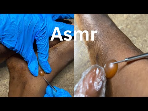 Your Favorites Extractions With Tools -😳🙊 very Satisfying