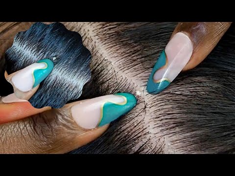 ASMR 1HR Nitpicking | Upclose Allzoomed | Super Attentive ~ silent 😮‍💨