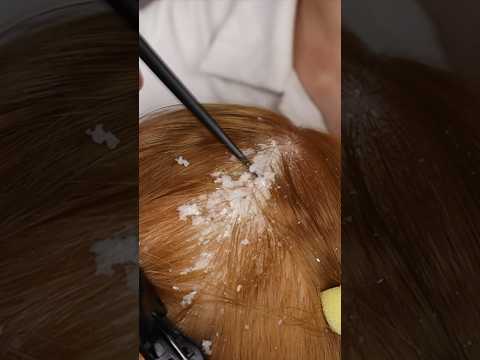 ASMR Satisfying Dandruff Removal #asmrscalpcheck #asmrscratching  #asmrtingles