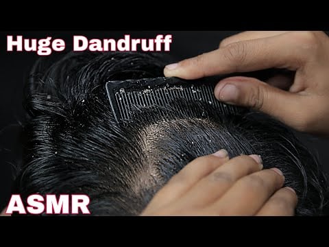 ASMR Dandruff Removal | Satisfying Dandruff Removal | Dandruff Scratching ASMR