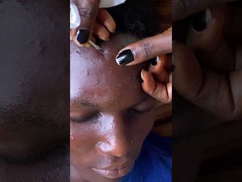 Huge pimple popping with few tools more nits #satisfying #asmr #nitpicking #skincare