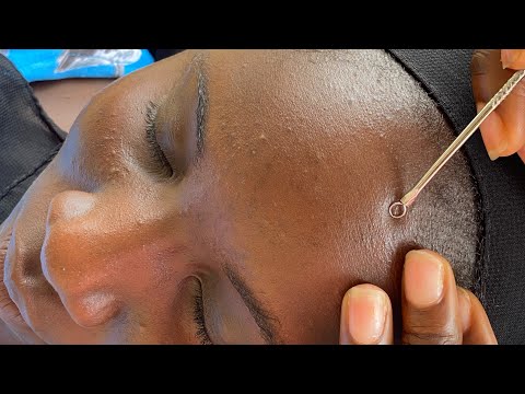 ASMR FACIALS NITPICKING AND CLEANING WITH TREATMENT FOR SLEEP AND RELAXATION ASMR