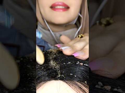 Dandruff Removal😱💆🏻‍♀️ #asmr #relax #visualtingle #relaxing #canada #asmrmassage #shorts #tingles