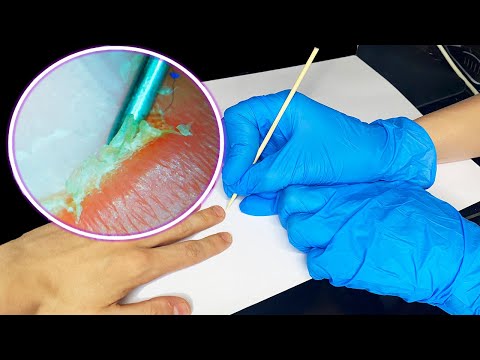 ASMR Removing Hangnails - Microscopic Cleaning 손거스러미 제거