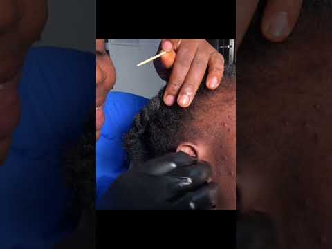 Wooden stick Ear Cleaning