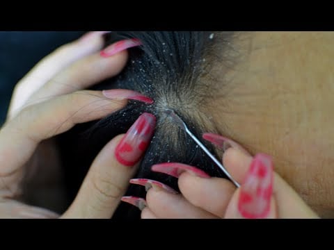 ASMR Scalp Check, Scalp Scratching, Scalp massage ( Added Head Scratching & Massage )