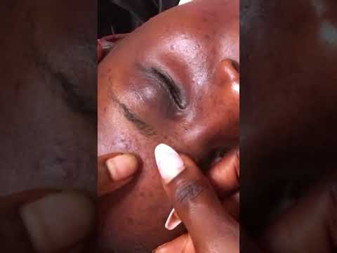 FACE NITPICKING ASMR #pimplepopping #facecleaning #facepimples #facepigmentation