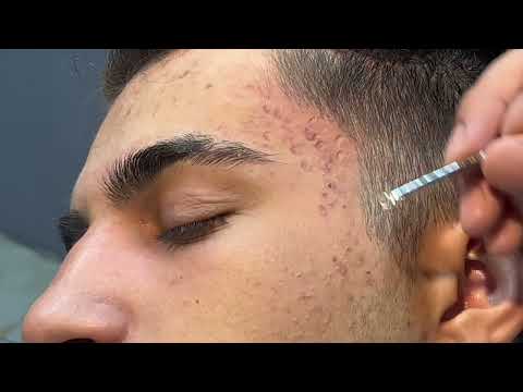 AD-FREE RELAXATION VIDEO / BLACK SPOTS CLEANING AND SKIN CARE