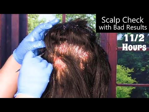 ASMR Scalp Check with Bad Results Compilation (Scalp Treatment, Whispering) Medical Roleplay