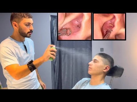 Blackhead and Acne Cleaning AD-FREE