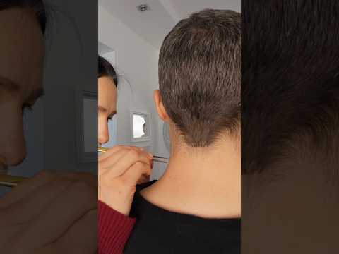 Skin treatment with tweezers