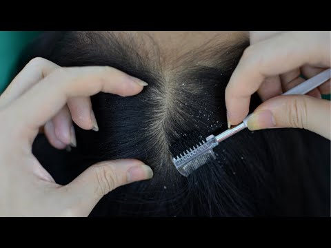 ASMR Scalp Treatment ( Scalp Check, Scalp Scratching, Head Scratching, Combing ) For Relieve Stress