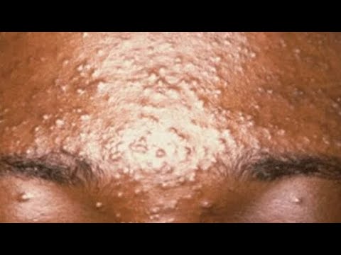 Asmr very satisfying nitpicking on a real person