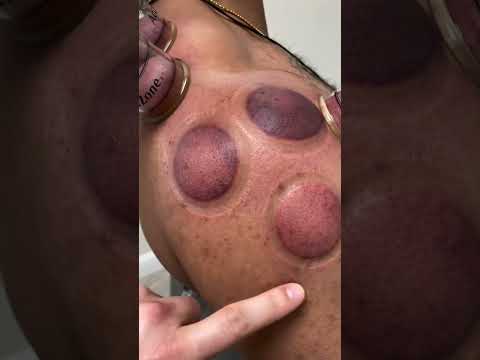 Cupping is great for shoulder pain 😁