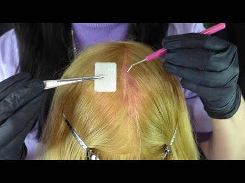 ASMR Bleach Fail ~ Scalp Check & First Aid Treatment (Whispered)