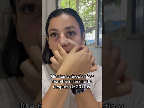 Mi rinoplastia