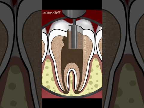 Dental decay restoration,Teeth cleaning animation, tooth cavity treatment#animation #asmr #trending
