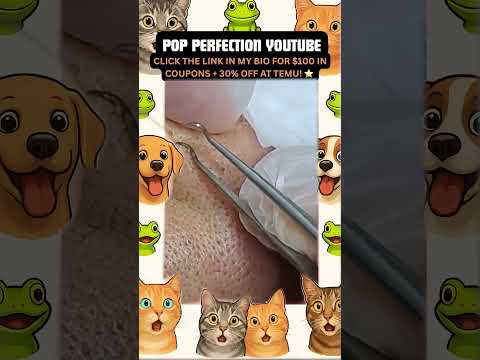 Wow! #pimpleremoval #pimple #pimples #shortsfeed #shortvideo #shorts #short #youtube #youtubeshorts