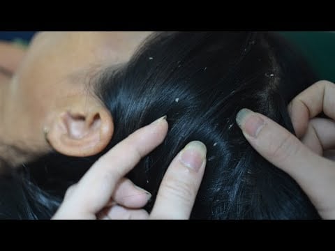 ASMR Scalp Check, Nape & Scalp Scratching, Relaxing Sounds For Relieve Stress, Headache, Anxiety