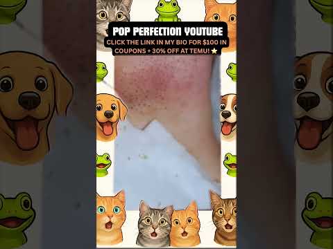 Wow! #pimpleremoval #pimple #pimples #shortsfeed #shortvideo #shorts #short #youtube #youtubeshorts