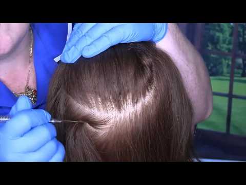 ASMR Scalp Check and Treatment (Scalp Scratching, Whispering) Medical RP