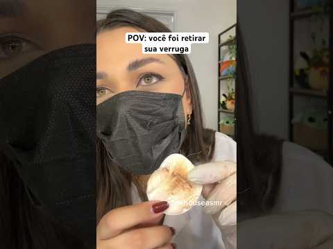 POV: você foi retirar sua verruga #shorts #humor