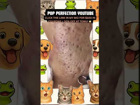 Wow! #pimpleremoval #pimple #pimples #shortsfeed #shortvideo #shorts #short #youtube #youtubeshorts