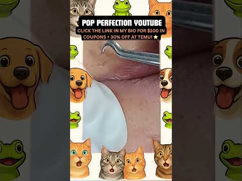 Wow! #pimpleremoval #pimple #pimples #shortsfeed #shortvideo #shorts #short #youtube #youtubeshorts
