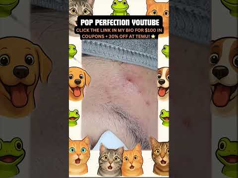 Wow! #pimpleremoval #pimple #pimples #shortsfeed #shortvideo #shorts #short #youtube #youtubeshorts