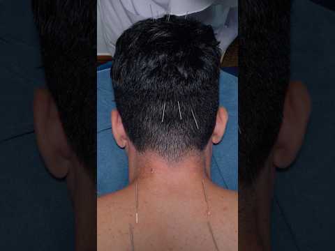 ASMR: Chinese Acupuncture, Fire Cupping & Tok Sen Massage for Insomnia #shorts