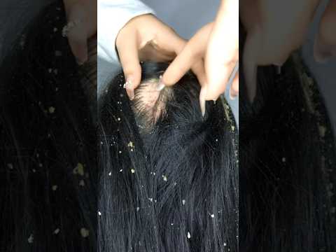 ASMR Dandruff Removal 💆🏻‍♀️ #asmr #satisfying #asmrhairplay #relax #asmrhaircare #tingles #shorts