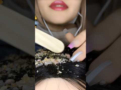 Dandruff Removal😱💆🏻‍♀️#asmr #scratching #scratchingasmr #visualtingle #relax #asmrmassage #shorts